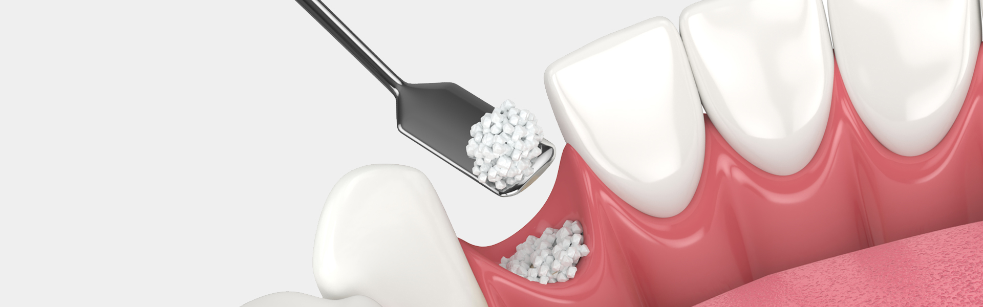 Dental Bone Grafting in Riverside, CA