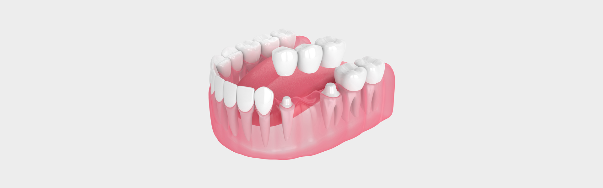 Dental Bridges in Riverside, CA