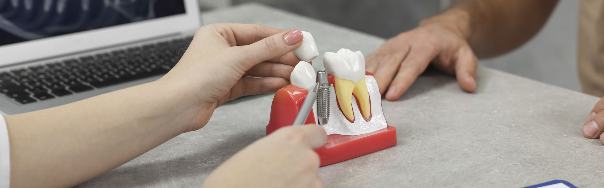 Dental Implants in Riverside, CA