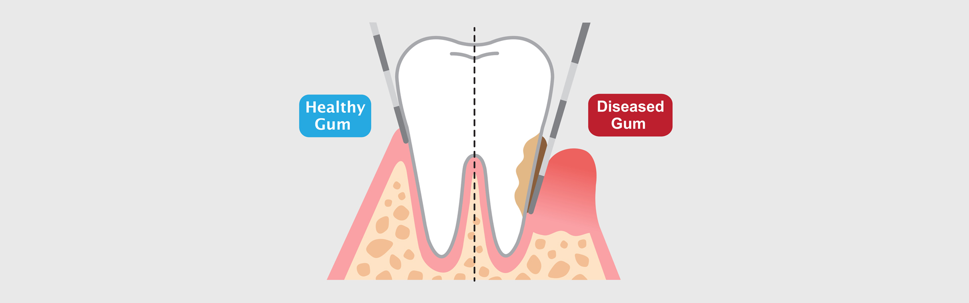 Crown Lengthening in Riverside, CA