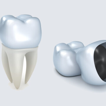 Porcelain Crowns