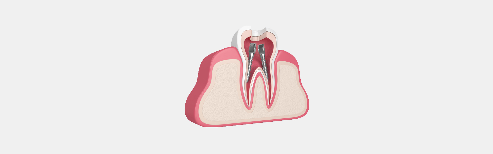 Root Canal Therapy in Riverside, CA